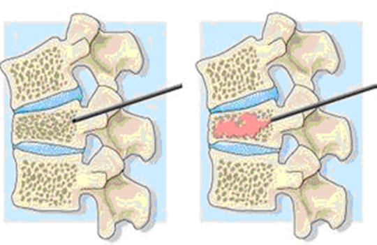 椎体压缩骨折                       注入骨水泥